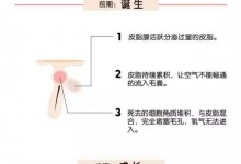 痘痘是如何产生的?-祛痘方法大全